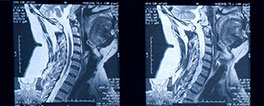 Free mri review San Jose, spine neurosurgeon San Jose, Atherton, Campbell, spine conditions in San Jose serving communities of Santa Clara County and San Mateo County - Redwood City, Palo Alto, Menlo Park, Santa Clara, San Mateo, Burlingame, South San Francisco, Campbell, Atherton, get back to life with out spine surgery