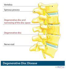 Pleasanton California spine surgery