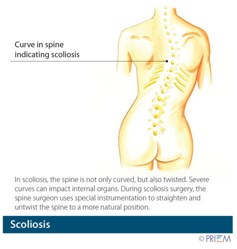 spine surgeon Palo Alto California, artificial disc replacement Northern California, spine center San Jose