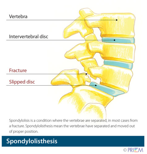 minimally invasive spine surgery Salinas California